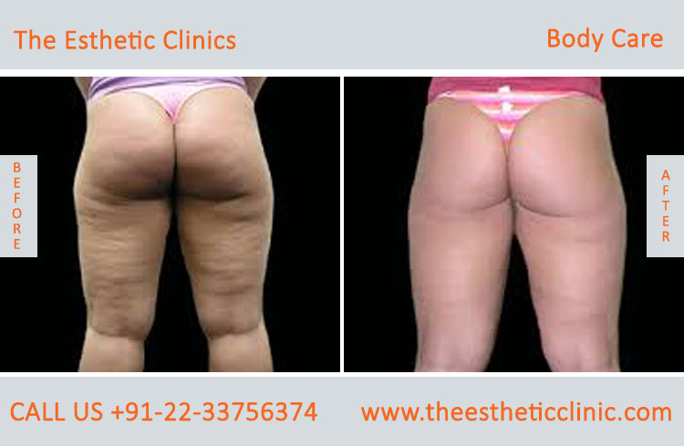 body care laser treatment before after photos in mumbai india (2)